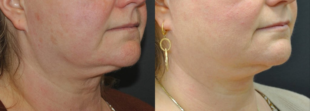 55-year-old 3 months after Morpheus Body to lower face, jawline and neck right oblique