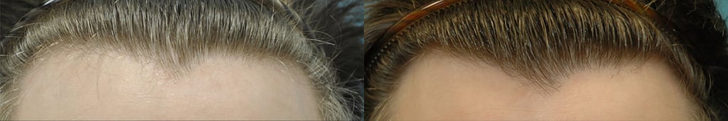 Forehead hairline thinning, improved after 3 PRP treatments