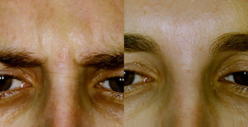 Botox glabella - 2