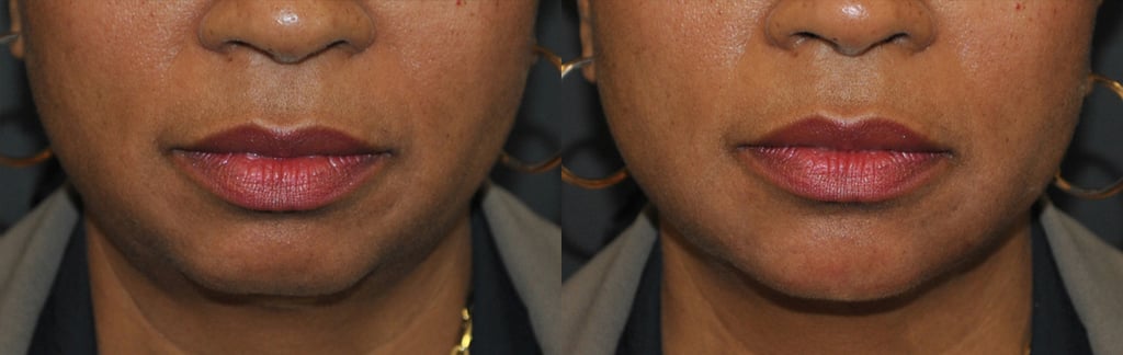 VOLUX jaw line and chin front