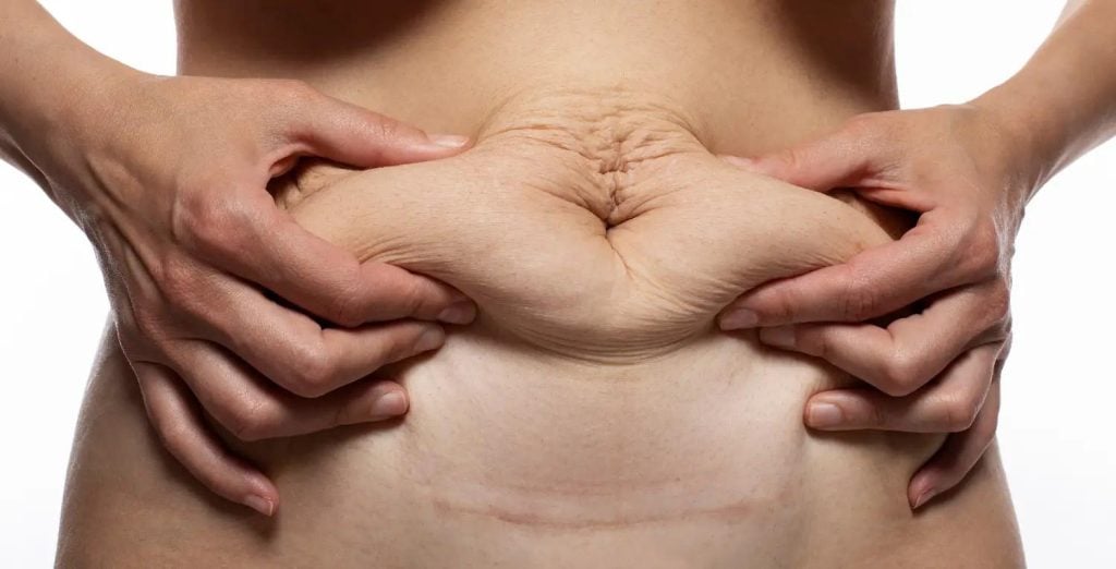 Person holding loose abdominal skin and stretch marks on the stomach.