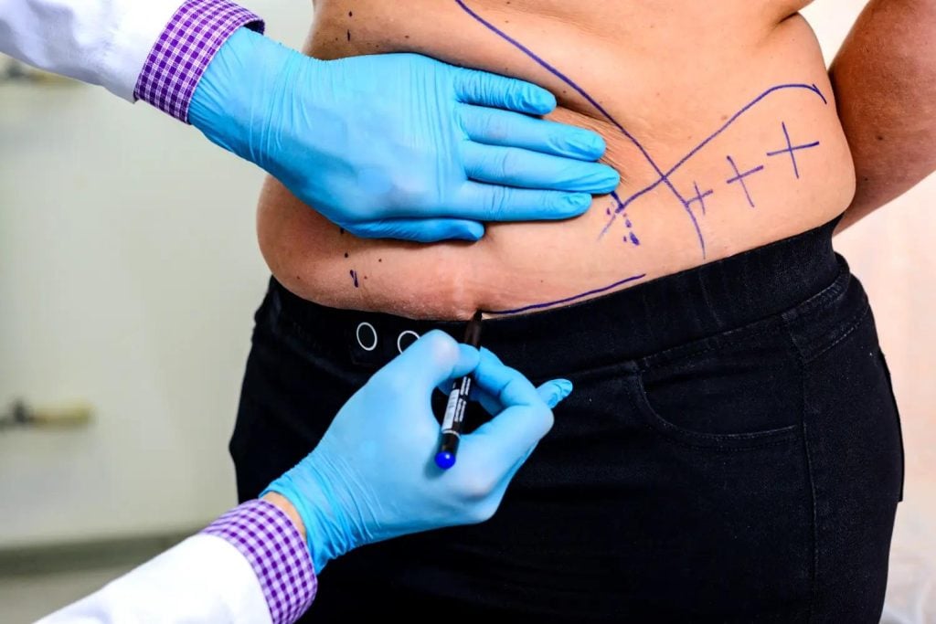 Doctor marking a patient’s lower abdomen before a tummy tuck procedure.