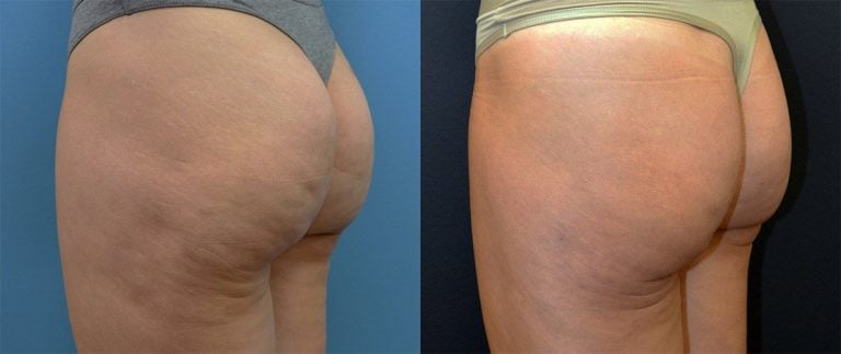 42-year-old fat injection post lipo depression, release of dimples, 5 months, left oblique