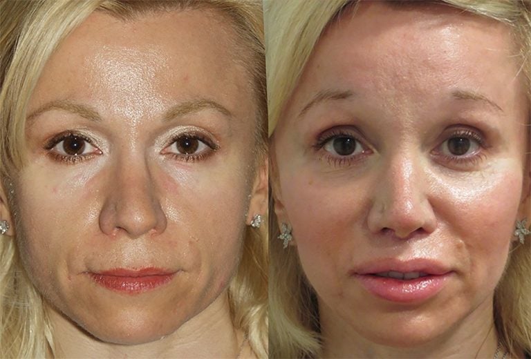 Fat injection lips and cheeks with chin implant, upper lip shortening, nasal tip plasty