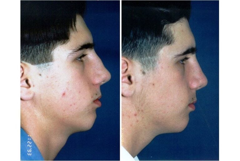 Sports injury, crooked nose and bump on the bridge. The projection and size of the tip was also reduced so that the bridge and the tip are now in line with each other. Side view.