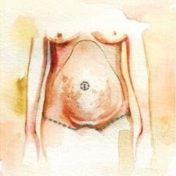 A. Incisions are made below the upper bikini or panty line and around the belly button.