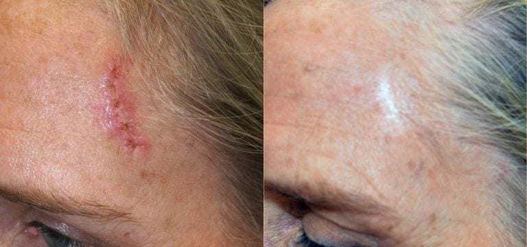 10 years after Mohs skin cancer excision and closure by Mohs dermatologist at University Center.