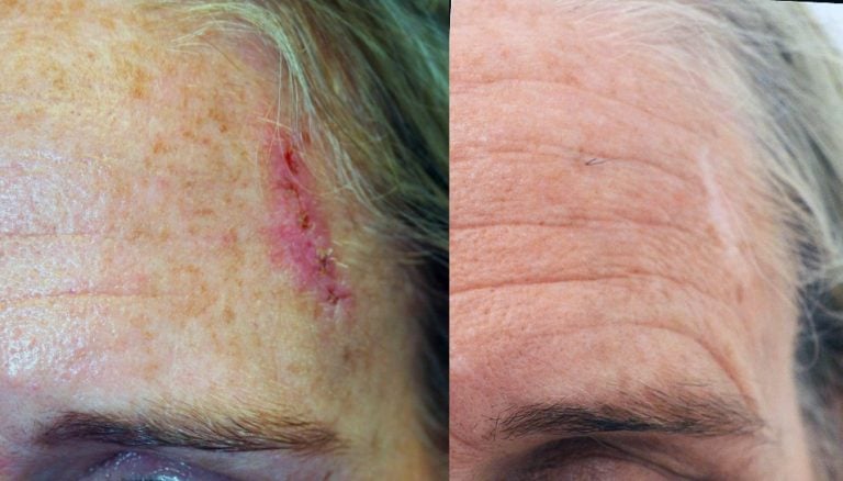 10 years after Mohs skin cancer excision and closure by Mohs dermatologist at University Center. Skin closure is at 90 degrees to natural skin lines. Skin closed with absorbable sutures leaving stitch marks.