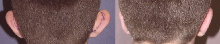 11-year-old-male-bilateral-otoplasty-back