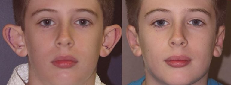 11-year-old-male-bilateral-otoplasty-front