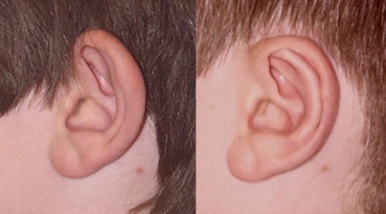 11-year-old-male-bilateral-otoplasty-left-ear-side