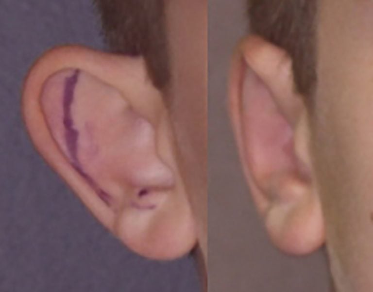11-year-old-male-bilateral-otoplasty-right-ear