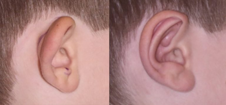 11-year-old-male-bilateral-otoplasty-right-ear-side