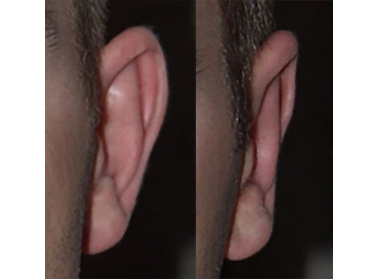 33-year-old-male-bilateral-otoplasty-left-ear