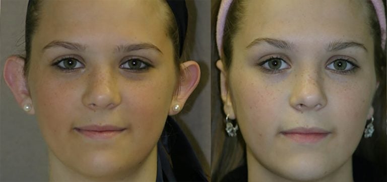 14-year-old female bilateral otoplasty, five months