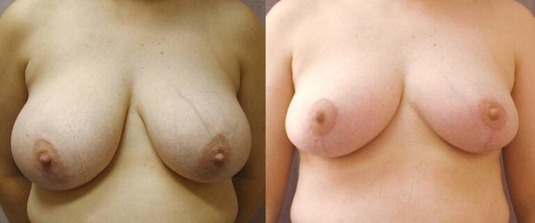 16-year-old-Breast-reduction-front