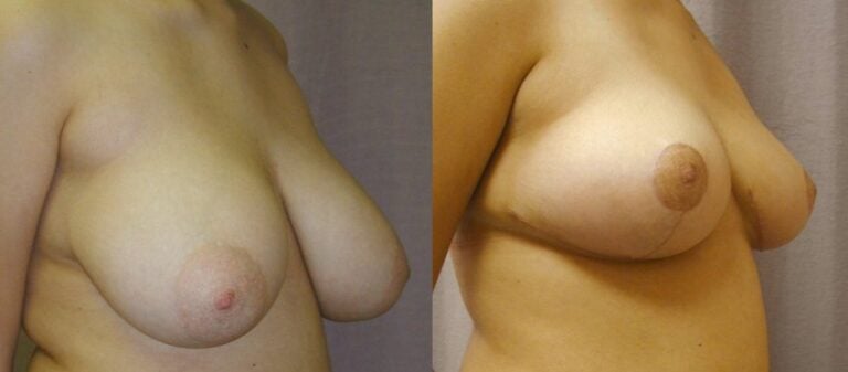 16-year-old-breast-reduction-inferior-pedicle-2-months-right-oblique