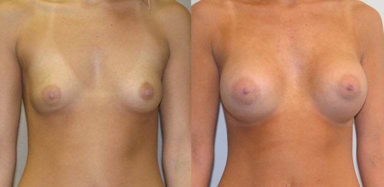 19-year-old breast augmentation 300cc Siltex periareolar incision 1 year