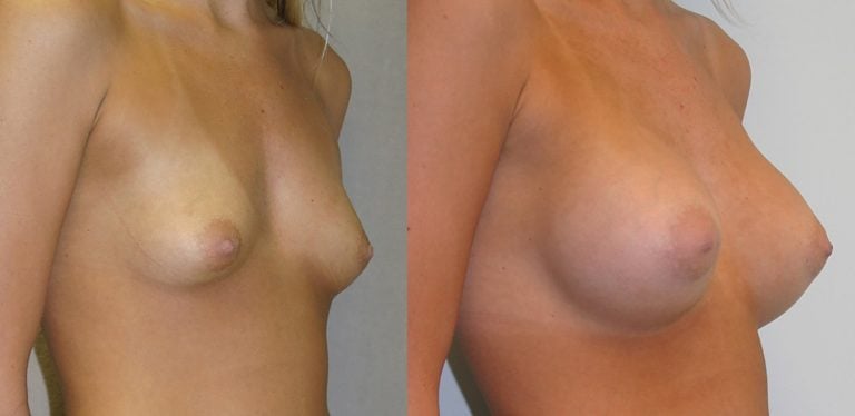 19-year-old breast augmentation 300cc Siltex periareolar incision 1 year, oblique