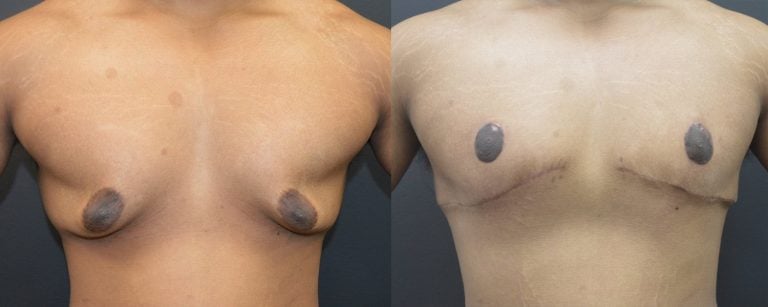 19-year-old, massive weight loss patient after gynecomastia and skin excision with transposition of nipple areola, 7 weeks