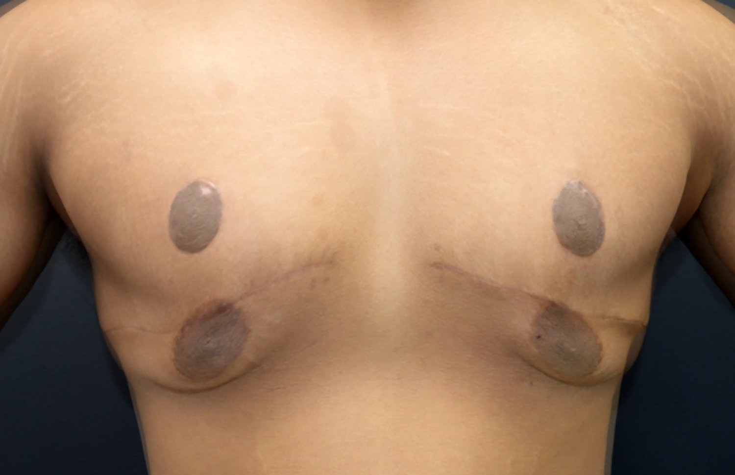 Before and after gynecomastia surgery with skin excision in a massive-weight-loss patient, Kirwan Plastic Surgery