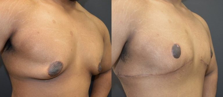 19-year-old, massive weight loss patient after gynecomastia and skin excision with transposition of nipple areola, before & after superimposed 7 weeks