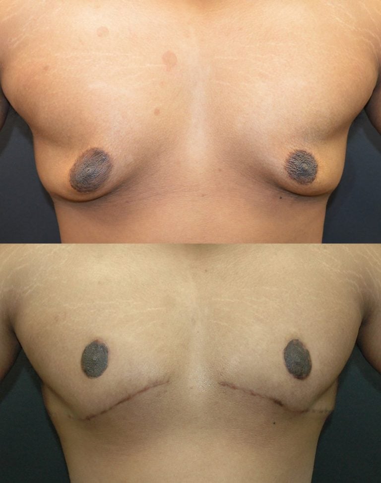 19-year-old-post-ubl-gynecomastia-6-months-front