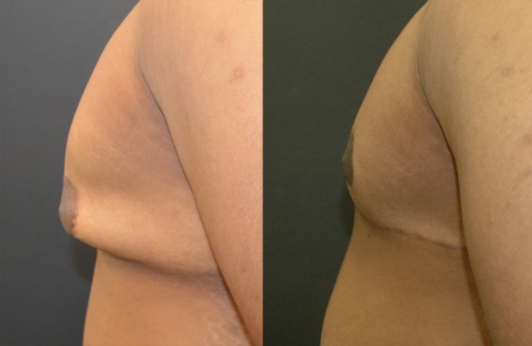19-year-old-post-ubl-gynecomastia-6-months-left-lateral