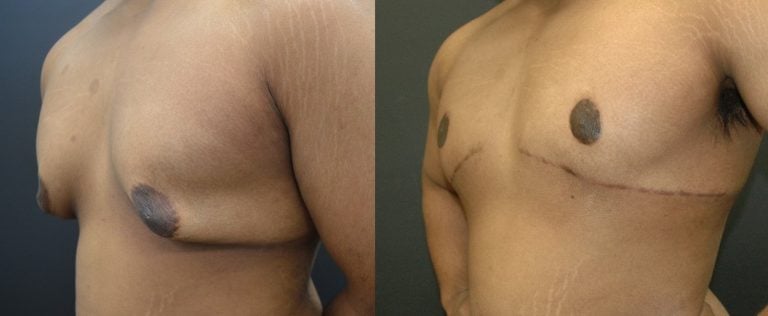 19-year-old-post-ubl-gynecomastia-6-months-left-oblique