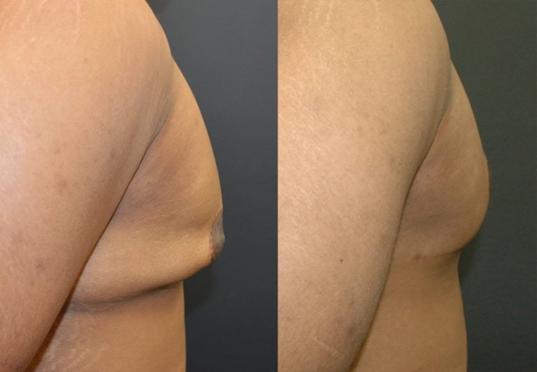 19 year old post ubl gynecomastia 6 months right lateral