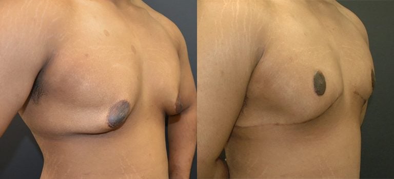 19-year-old-post-ubl-gynecomastia-6-months-right-oblique