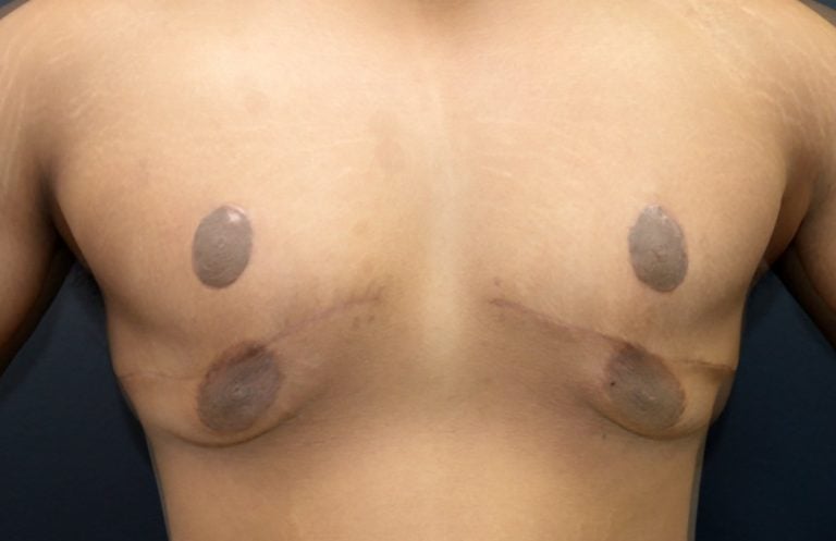 19-year-old-massive-weight-loss-patient-after-gynecomastia-and-skin-excision-with-transposition-of-nipple-areola-before-after-superimposed-7-weeks