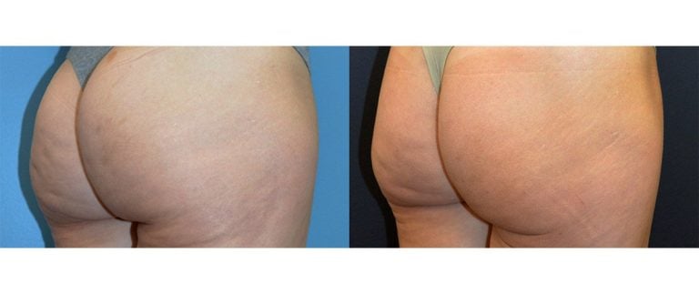 42-year-old fat injection post lipo depression, release of dimples, 5 months, right oblique