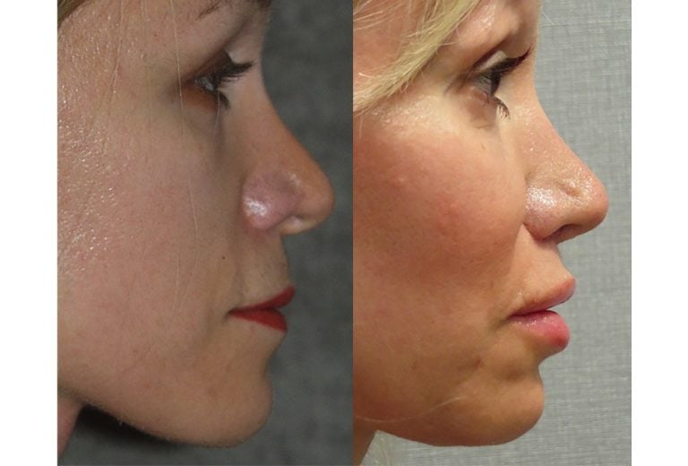 Fat injection lips and cheeks with chin implant, upper lip shortening, nasal tip plasty, side view