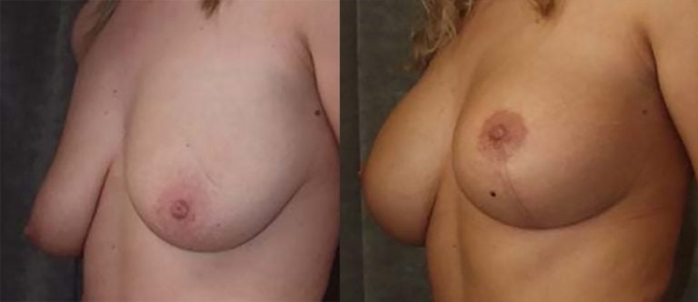 23-year-old, 300cc low profile, vertical mastopexy reduction, oblique, one year