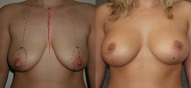 23-year-old, 300cc low profile, vertical mastopexy reduction, one year
