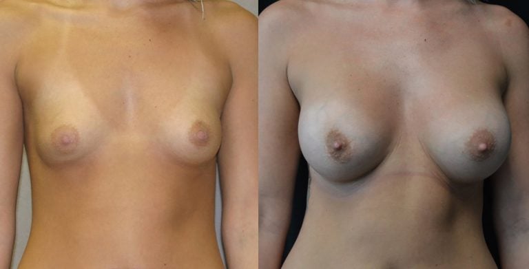 19-year-old breast augmentation 300cc Siltex periareolar incision 1 year