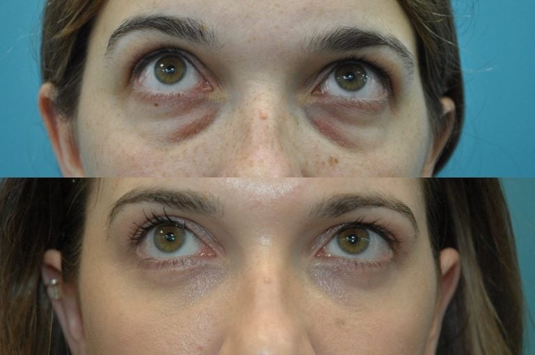 The upward gaze of a 27-year old patient who has undergone upper and lower blepharoplasty with transposition of medial and middle fat pads