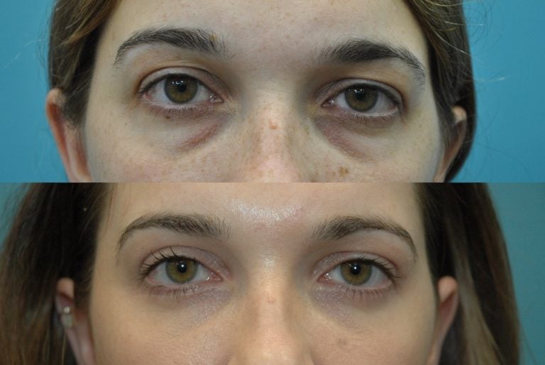 The same patient is seen looking forward with an external approach. 