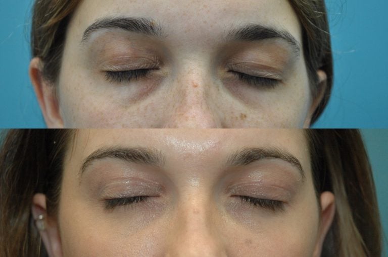 The same 27-year-old patient is seen here with her eyes closed. The focus is on the upper eyelid scar.