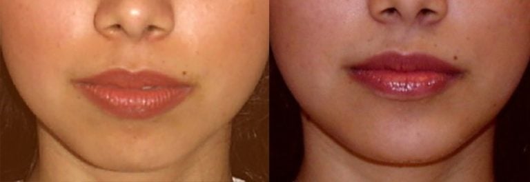 28-year-old-4-months-front