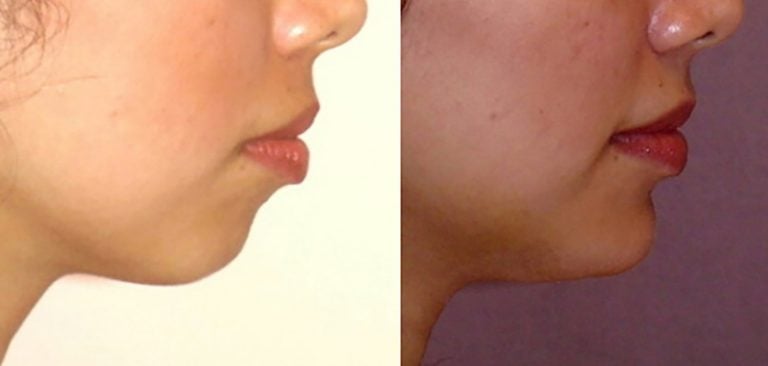 28-year-old-4-months-side