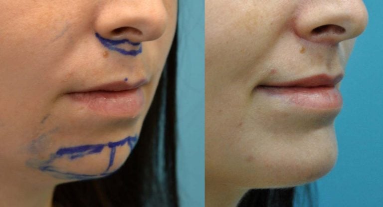 29 year-old patient, lip lift and chin implant - 2