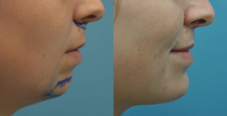 29 year old upper lip shortening with chin implant 3 months after surgery side view