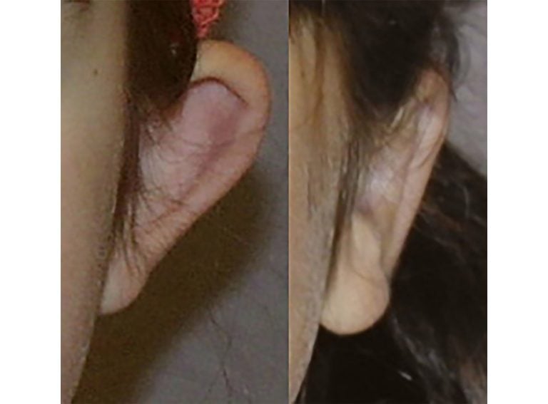 7-year-old female bilateral otoplasty, left ear