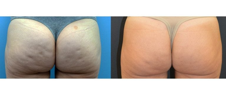 42-year-old fat injection post lipo depression, release of dimples, 5 months