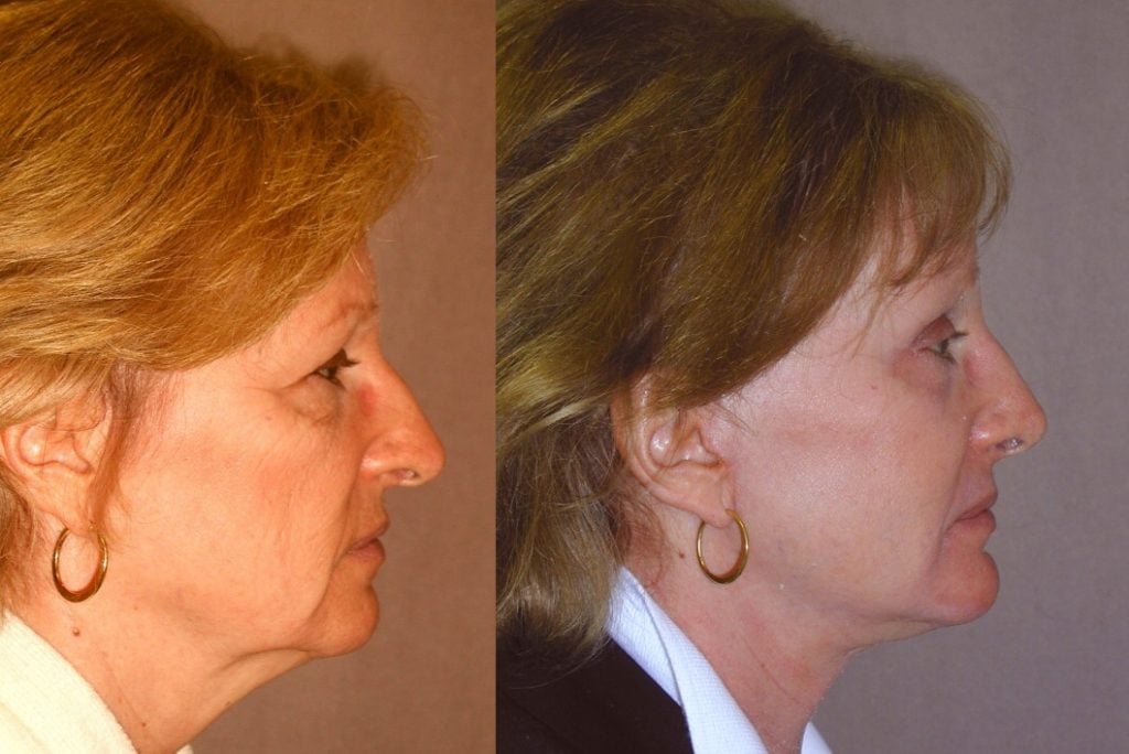 Facelift Norwalk side view