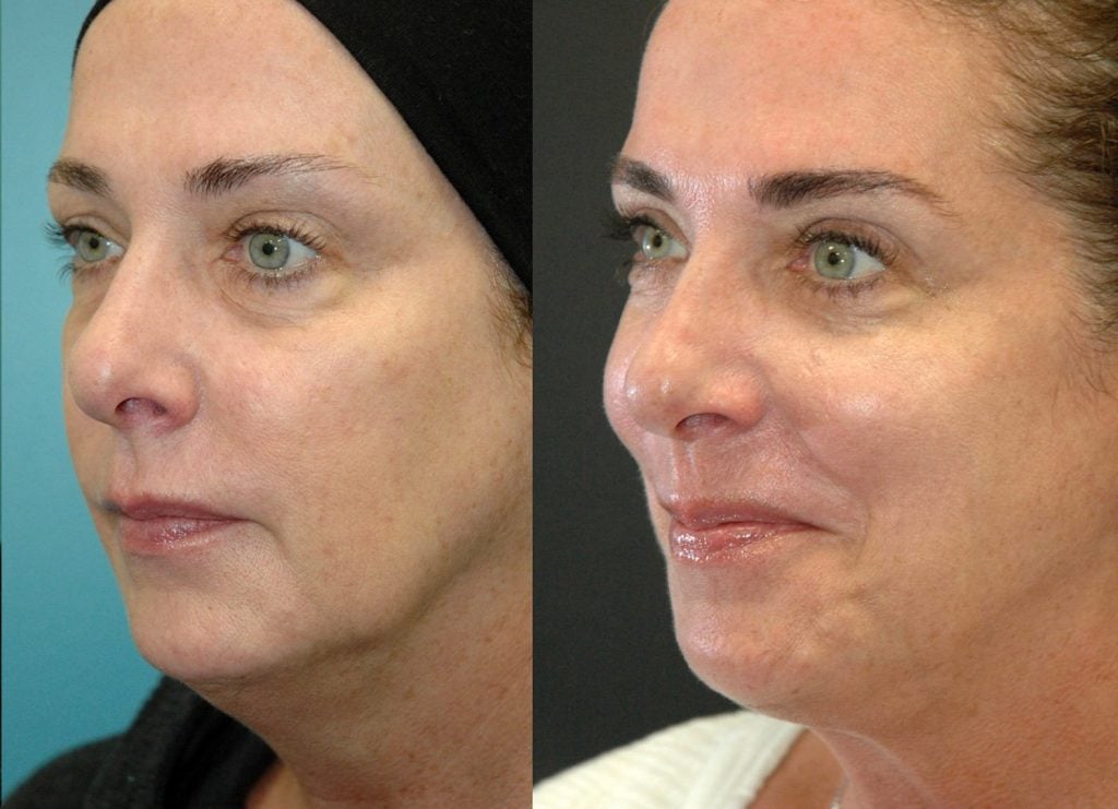 Facetite & Morpheus face and neck 5 months oblique