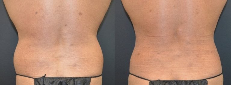 32-year-old-Liposuction-iliac-crests-650-cc-each-side-PAL-6-months-back