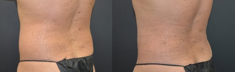 32-year-old-Liposuction-iliac-crests-650-cc-each-side-PAL-6-months-left-oblique